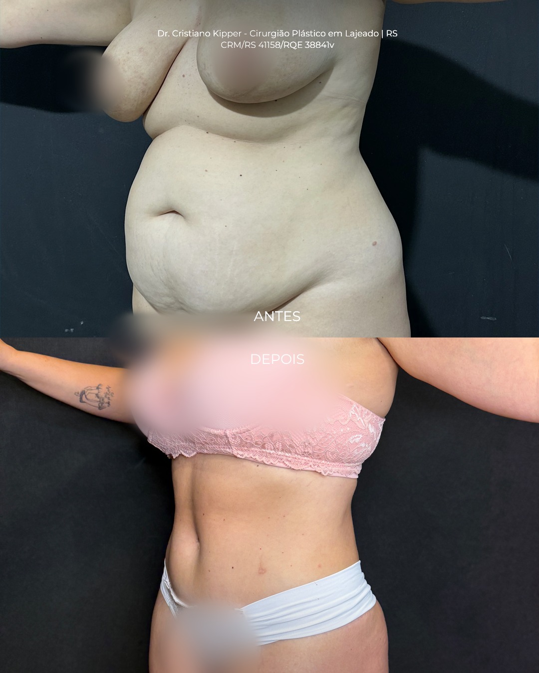 Resultado antes e depois de cirurgia de contorno corporal realizada pelo Dr. Cristiano Kipper